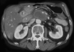 Recurrent Carcinoma of the Pancreas - CTisus CT Scan