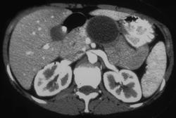 Pseudocyst - CTisus CT Scan