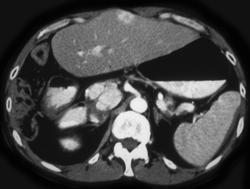 Hepatoma Metastatic to the Pancreas - CTisus CT Scan