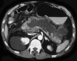 Ductectatic Carcinoma of the Pancreas - CTisus CT Scan