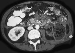 Pancreatic Abscess - CTisus CT Scan