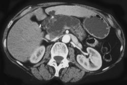 Ductectatic Tumor - CTisus CT Scan