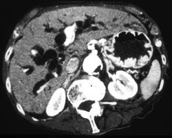 Dilated Common Bile Duct (CBD) and Intrahepatic Ducts - CTisus CT Scan