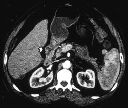 Small Carcinoma of the Body of the Pancreas - CTisus CT Scan