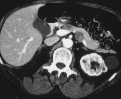 Melanoma Metastatic to the Pancreas - CTisus CT Scan