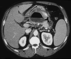 Pancreatic Abscess - CTisus CT Scan