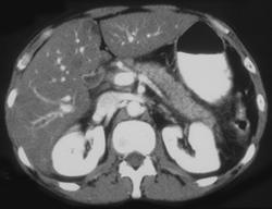 Mild Pancreatitis - CTisus CT Scan