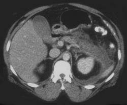 Pancreatitis With Fluid in Left Anterior and Posterior Pararenal Spaces - CTisus CT Scan