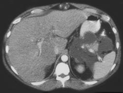 Acute Pancreatitis - CTisus CT Scan