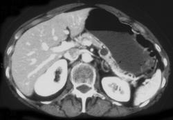 Pancreatic Cyst - CTisus CT Scan