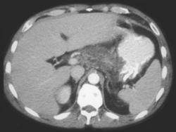 Acute Pancreatitis - CTisus CT Scan