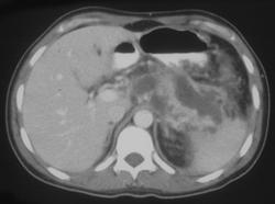 Acute Pancreatitis With Splenic Involvement - CTisus CT Scan