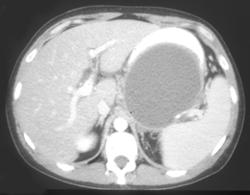 Huge Pseudocyst - CTisus CT Scan