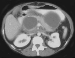 Pseudocysts - CTisus CT Scan