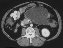 Pseudocyst Involves the Left Psoas Muscle - CTisus CT Scan