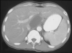 Pseudocyst Dissects Into Porta - CTisus CT Scan