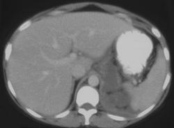 Pseudocyst Tracks Into the Posterior Mediastinum - CTisus CT Scan