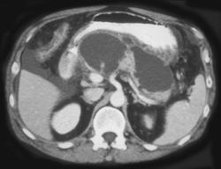 Multiple Pseudocysts - CTisus CT Scan