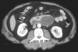 Pseudocyst - CTisus CT Scan