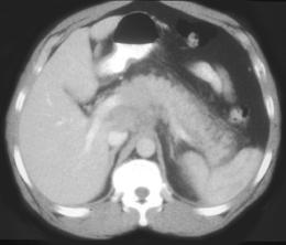 Acute Pancreatitis Due to Lymphoma - CTisus CT Scan