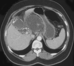 Acute Pancreatitis (gallstone Pancreatitis) - CTisus CT Scan