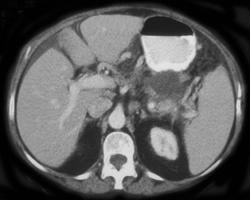 Pancreatitis With Splenic Vein Occlusion - CTisus CT Scan