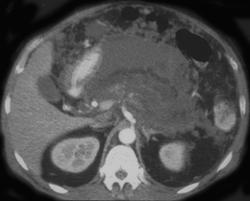 Pancreatic Necrosis - CTisus CT Scan