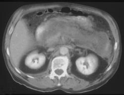 Pancreatic Necrosis (note Small SMA) - CTisus CT Scan