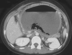 Pancreatic Abscess and Necrosis - CTisus CT Scan