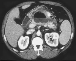 Pancreatic Abscess - CTisus CT Scan