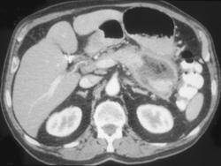 Pancreatic Abscess - CTisus CT Scan