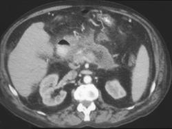 Pancreatic Abscess - CTisus CT Scan