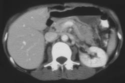 Pancreatic Abscess - CTisus CT Scan