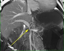 Cancer of the Pancreas Encases the Portal Vein - CTisus CT Scan