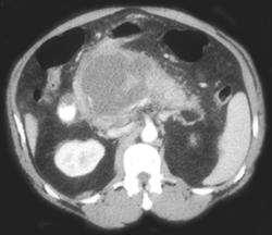 Acute Hemorrhagic Pancreatitis - CTisus CT Scan