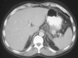 Pseudoaneurysm of the Splenic Artery - CTisus CT Scan