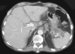 Splenic Artery Pseudoaneurysm Developed Over 10 Days (2 Scans, 10 Days Apart) - CTisus CT Scan