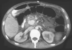 Gastroduodenal Artery Pseudoaneurysm - CTisus CT Scan