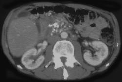 Portal Vein Thrombus Secondary to Pancreatitis - CTisus CT Scan