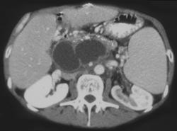 Pancreatic Pseudocysts With Portal Vein Thrombosis - CTisus CT Scan