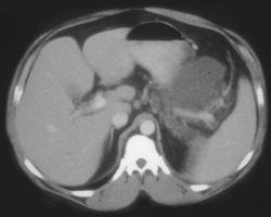 Acute Pancreatitis Involves the Spleen - CTisus CT Scan