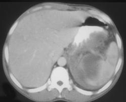 Pseudocyst Tracks Into the Spleen - CTisus CT Scan