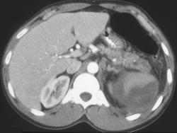 Splenic Rupture Secondary to Chronic Acute Pancreatitis - CTisus CT Scan