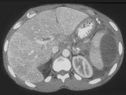 Pseudocyst Tracks Beneath the Splenic Capsule - CTisus CT Scan