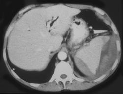 Subcapsular Splenic Bleed in Patient With Chronic Pancreatitis - CTisus CT Scan