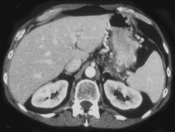 Pseudocyst Results in Splenic Occlusion (see Collaterals) - CTisus CT Scan