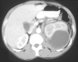 Pseudocyst Tracks Into Posterior Pararenal Space - CTisus CT Scan