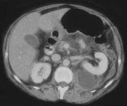 Pseudocyst Displaces the Kidney - CTisus CT Scan