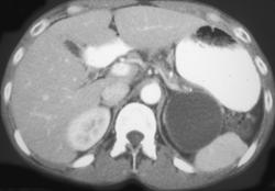 Pseudocyst Tracks Into Perirenal Space - CTisus CT Scan