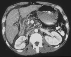 Chronic Pancreatitis - CTisus CT Scan